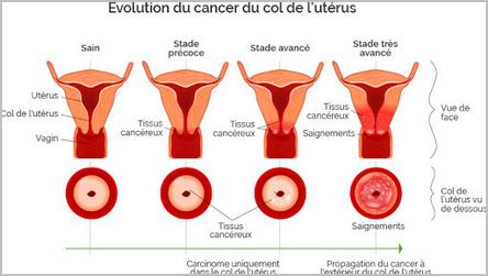 stades du cancer du col de l'utérus