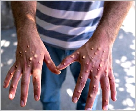 les éruptions cutanées de la variole du singe sur les mains d'un malade